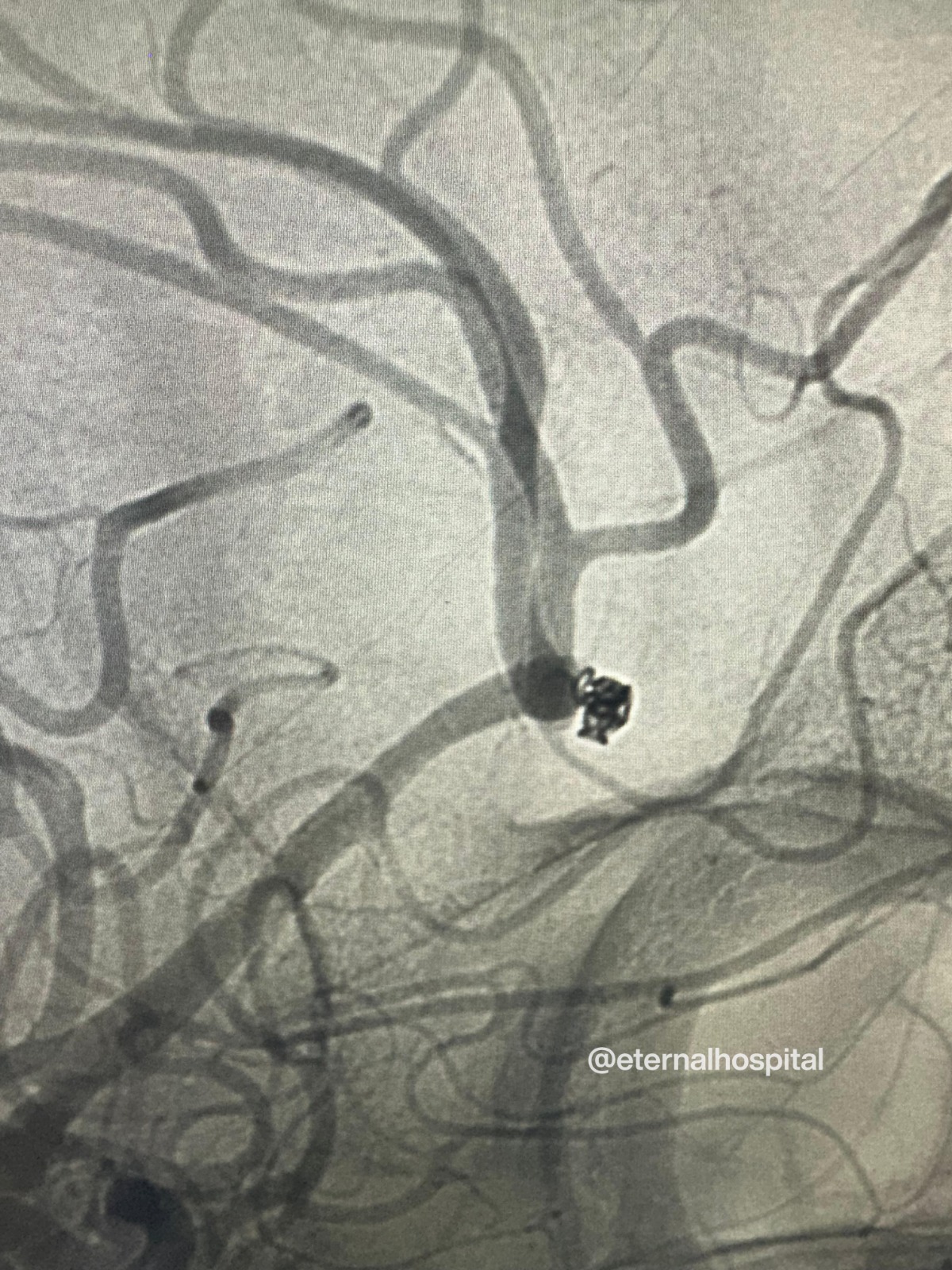 Aneurysm Coiling How Modern Technology Prevents Brain Hemorrhage