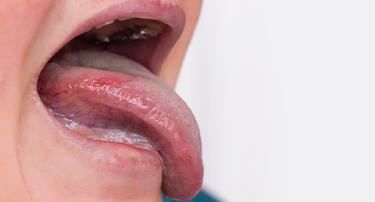 Leukoplakia Patches: Symptoms, Causes and Treatments