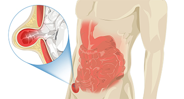 How Much Does A Hernia Operation Cost In Jaipur, India?
