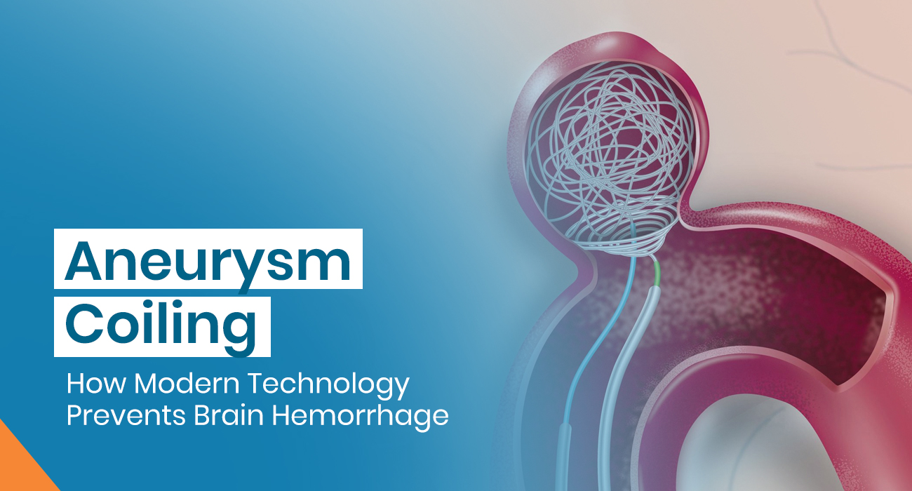 Aneurysm Coiling: How Modern Technology Prevents Brain Hemorrhage