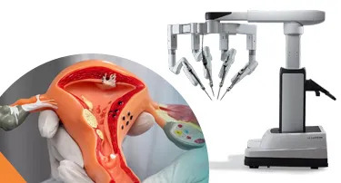 Robotic Myomectomy for Fibroids: Fertility, Recovery & Success Rates
