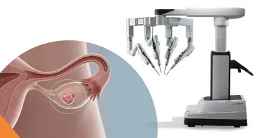 Robotic Ovarian Cyst Removal: Cost, Recovery & Risks