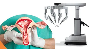 All You Need to Know About Robotic Radical Hysterectomy