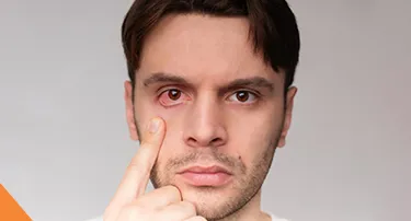 Effective Home Remedies for Eye Infections: How to Treat Naturally