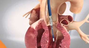 Exploring the Procedure: A Step by Step Guide to TAVI