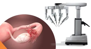 Robotic Oophorectomy: Indications, Recovery & Hormonal Effects