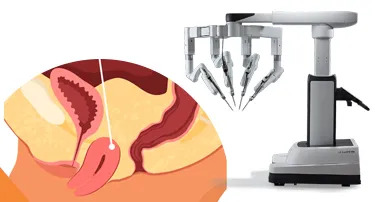 Uterine Prolapse Treatment Without Hysterectomy – Robotic Options