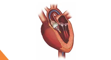 What Is Structural Heart Disease? A Complete Patient Guide